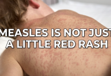 Measles Surges in PA