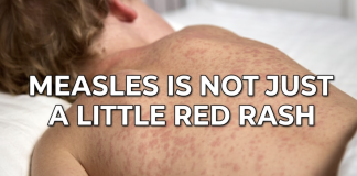 Measles Surges in PA