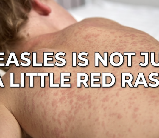 Measles Surges in PA